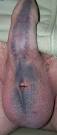http://www.vasectomy-information.com/pictures/bruisingonpenis/bruising1small.jpg