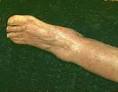 Cause, Sign and Symptoms of <b>Beriberi</b> Disease | Health Information