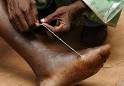Morgellons Disease is not skin