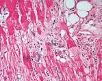 Echocardiographic Description of Recurrent Idiopathic Giant-Cell ...