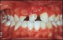 case study: Dental and oral lesions associated with <b>focal dermal</b>
