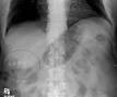 Gallstone - Wikipedia, the free encyclopedia