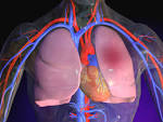 PULMONARY EMBOLISM Medical, Health & Disease Pictures & Images