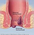 Post Pregnancy Hemorrhoids