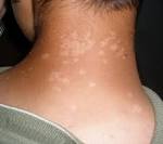 <b>Tinea Versicolor</b> on neck
