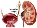 How To Naturally Treat Kidney Stones With Nutrition | Tom Corson-