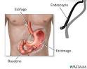 <b>Endoscopia</b> gástrica