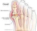 Gout diet | gout treatment | gout symptoms | what is gout caused by
