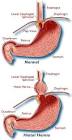 Dietetic advice - Heartburn, Acid reflux and acid reflux disease ...