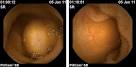 <b>Tumor</b> mass (<b>jejunal</b> carcinoid www.sciencedirect.com