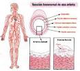 la <b>arteriosclerosis</b>.