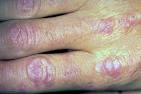 Dermatomyositis Picture (Hardin MD Super Site Sample)