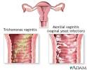 Microbial or bacterial Vaginosis diagnosis | InfoHealths.