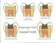 <b>Cracked tooth syndrome</b>
