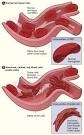 Group 5 - Blood Disorders and Blood Defects - WolfWikis