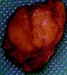 220px-Insulinoma.jpg