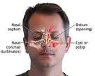 Nasal polyps are fleshy growths on the