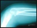 X-ray Sinuses, Nasal Bones