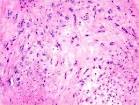 <b>Myoepithelioma</b>, Malignant