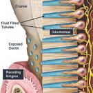 <b>dentin sensitivity</b> mechanism