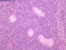 Like lymphoma, <b>plasmacytoma</b>