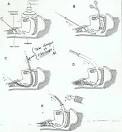 Retrograde Tracheal <b>Intubation</b>