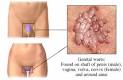 Genital Warts - EmpowHER.