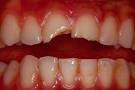 Anterior <b>Fractured tooth</b>