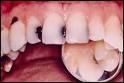 Cavity Pain Relief