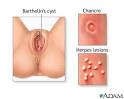 Genital sores (