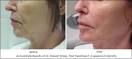 Exilis Weiss B A Chin 3xJPG