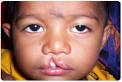 Multifactorial Birth Defects | Medindia
