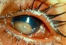 <b>Xerophthalmia</b> photos and related clinical trials