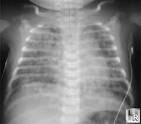 with <b>Meconium Aspiration</b>