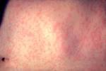 Measles - Wikipedia, the free encyclopedia