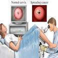 Cervical Cancer: Colposcopy