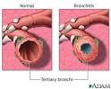 Bronchitis and normal condition in tertiary bronchus