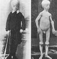 progeria: Latest News