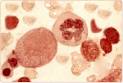 <b>Aplastic Anemia</b>