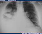 Pleural Effusions Due to PULMONARY EMBOLISM