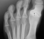 File:<b>Hallux varus</b>.jpg
