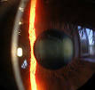 Cornea - Wikipedia, the free encyclopedia