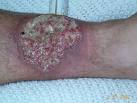 <b>Pyoderma gangrenosum</b>.jpg