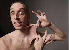 Ehlers-Danlos Syndrome