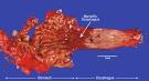 What Does Esophageal Cancer