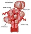 Fibroids What are Uterine Fibroids? Treatment of fibroids ...