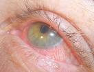 <b>iritis</b>.JPG