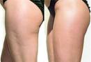 cellulite    Bellanina101s Blog