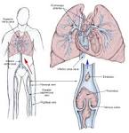 a pulmonary <b>embolism</b>.