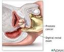 Digital Rectal Examination (DRE) - definition | Health Dictionary